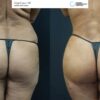 Full Waist Vaser Lipo before after